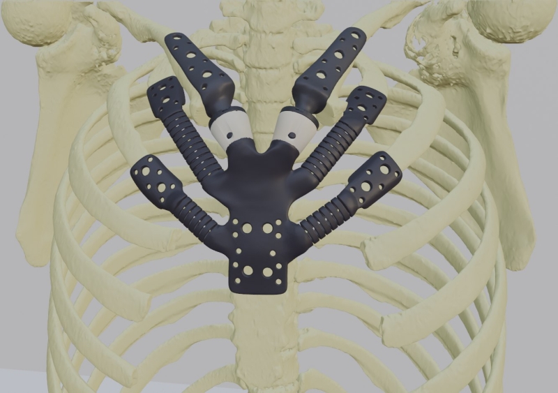 В России создали гибкий имплантат грудины — он полностью восстанавливает биомеханику дыхания